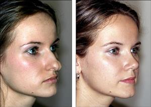 Top 10 Rhinoplasty Tips For Before and After Surgery